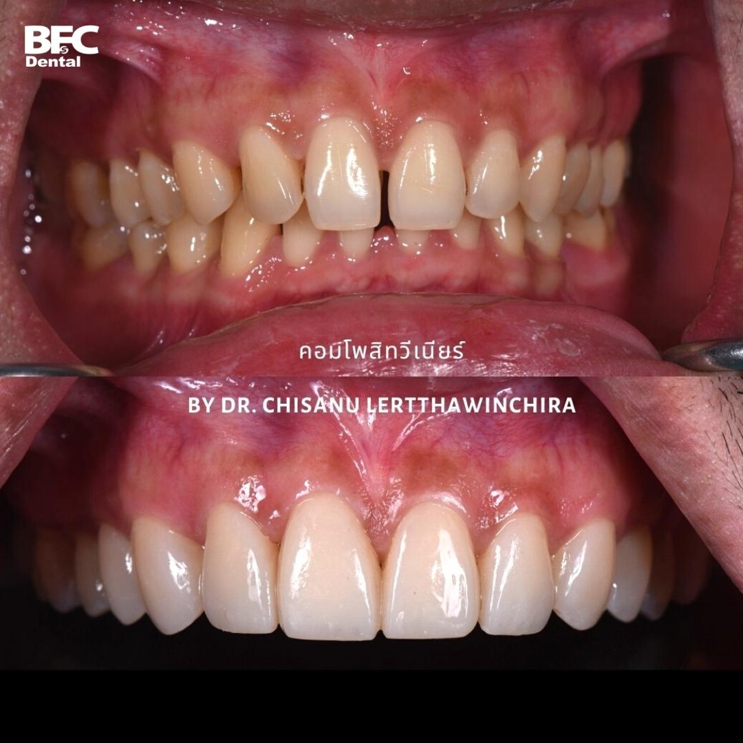 Facettes Dentaires — BFC Dental