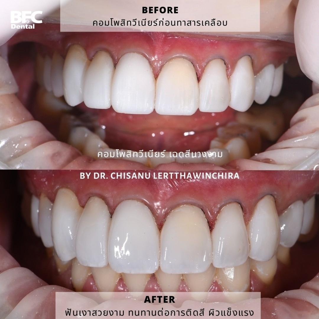 Facettes Dentaires — BFC Dental