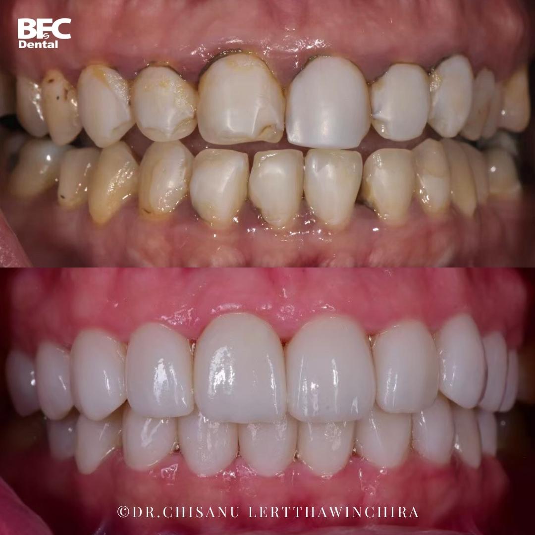 Facettes Dentaires — BFC Dental