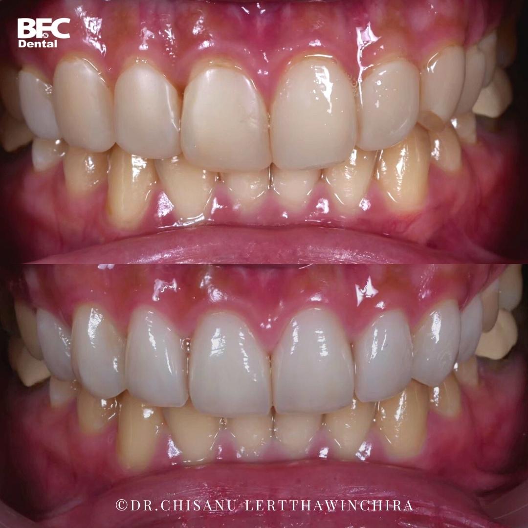 Facettes Dentaires — BFC Dental