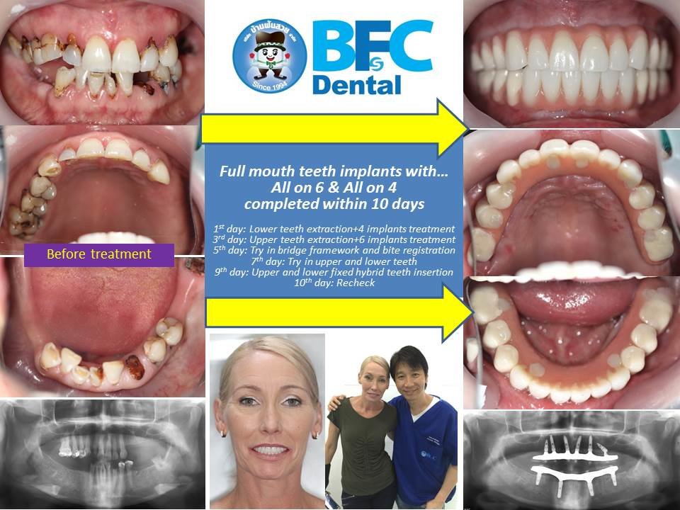All-On-6 — BFC Dental