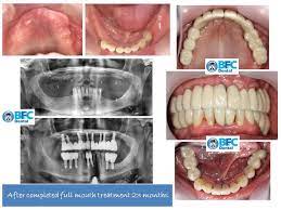 All-On-6 — BFC Dental