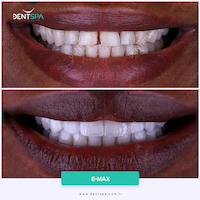 Facettes Emax — DentSpa Clinic