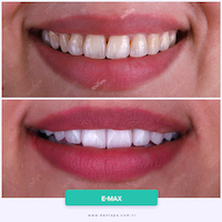 Facettes Emax — DentSpa Clinic
