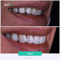 Facettes Emax — DentSpa Clinic