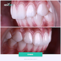 Facettes Emax — DentSpa Clinic