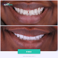 Facettes Emax — DentSpa Clinic