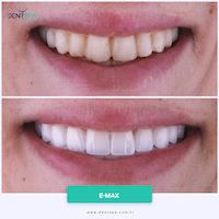 Facettes Emax — DentSpa Clinic