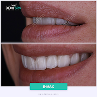 Facettes Emax — DentSpa Clinic