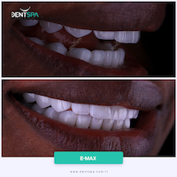 Facettes Emax — DentSpa Clinic