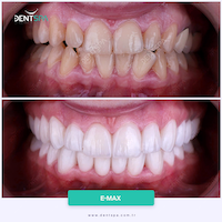 Facettes Emax — DentSpa Clinic
