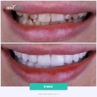 Facettes Emax — DentSpa Clinic