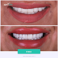 Facettes Emax — DentSpa Clinic