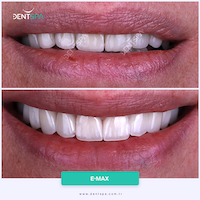 Facettes Emax — DentSpa Clinic
