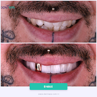 Facettes Emax — DentSpa Clinic