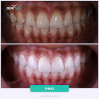 Facettes Emax — DentSpa Clinic