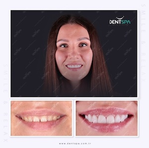 Facettes Emax — DentSpa Clinic