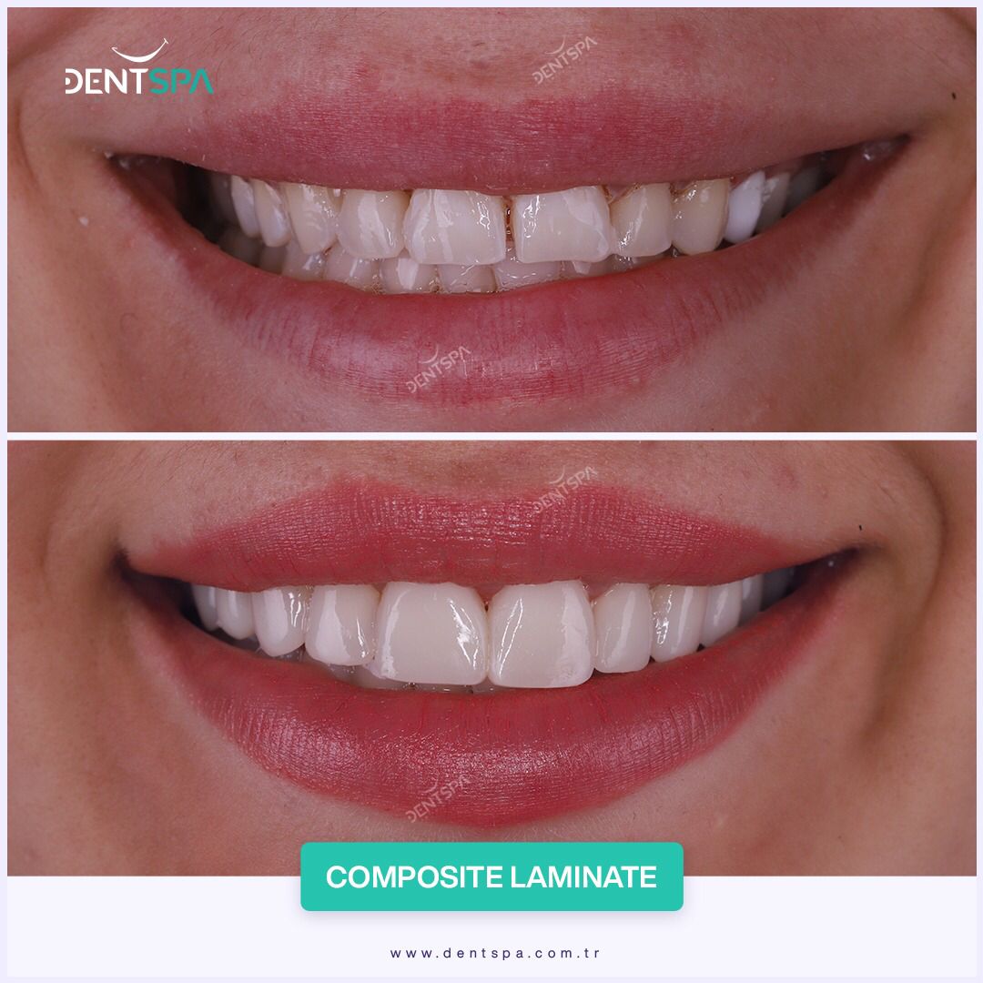 Facettes Pelliculaires — DentSpa Clinic