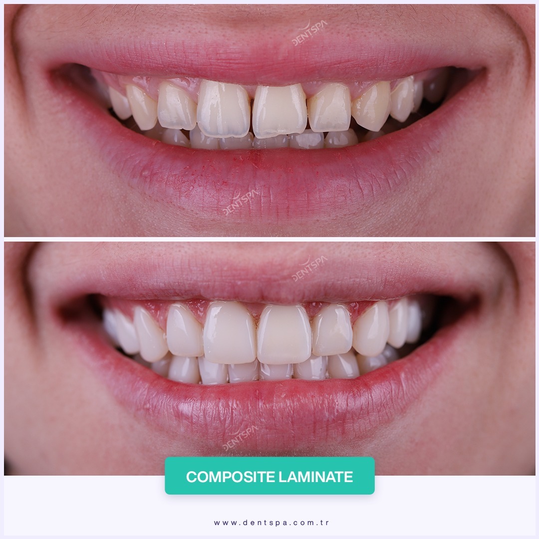 Facettes Pelliculaires — DentSpa Clinic