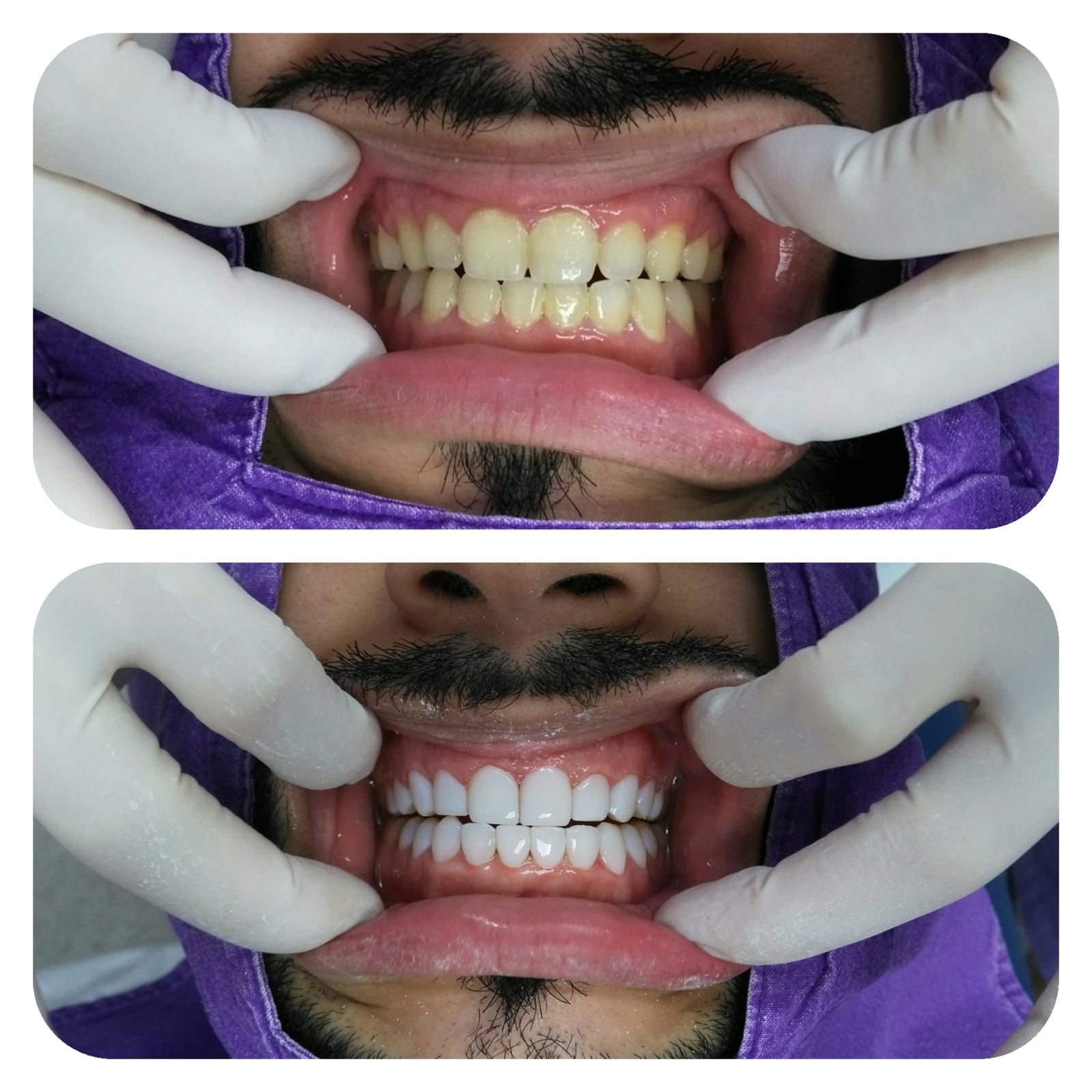 Facettes Pelliculaires — DentSpa Clinic