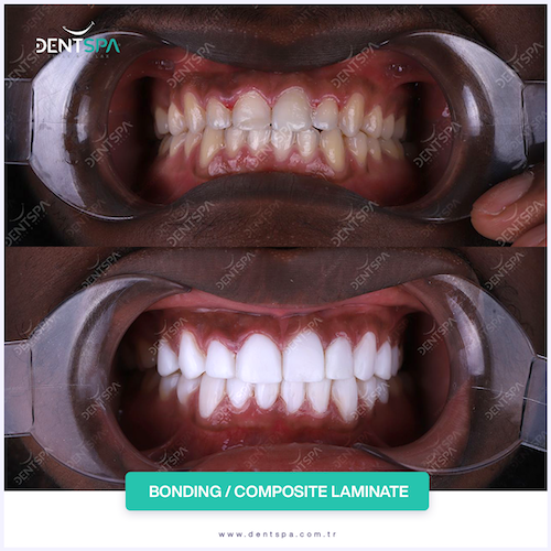Facettes Pelliculaires — DentSpa Clinic