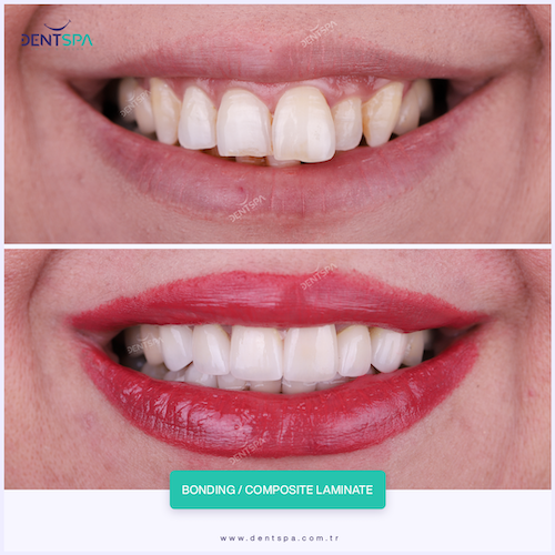 Facettes Pelliculaires — DentSpa Clinic