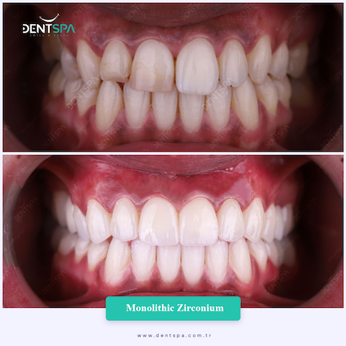 Couronnes Zircones — DentSpa Clinic