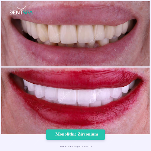 Couronnes Zircones — DentSpa Clinic