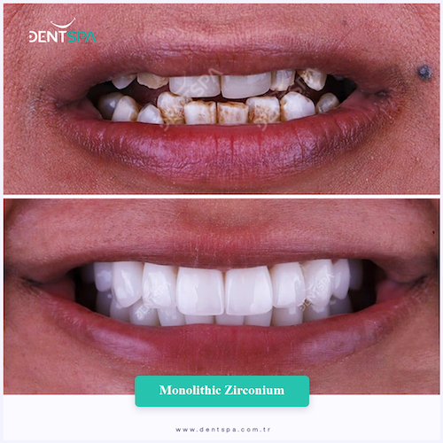 Couronnes Zircones — DentSpa Clinic