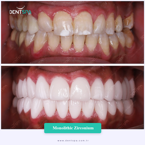 Couronnes Zircones — DentSpa Clinic