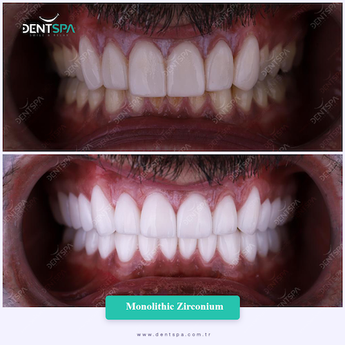 Couronnes Zircones — DentSpa Clinic