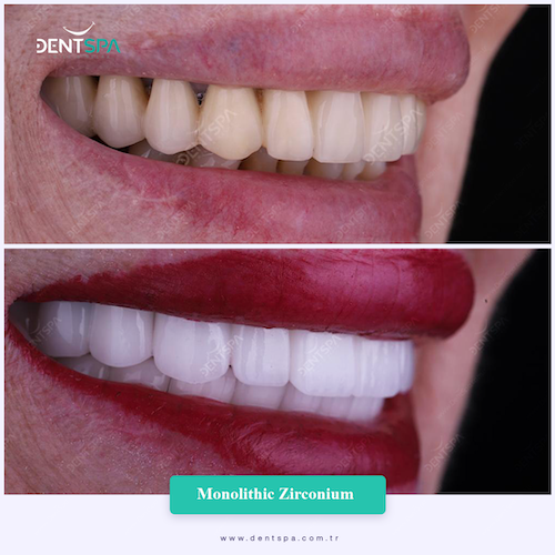 Couronnes Zircones — DentSpa Clinic