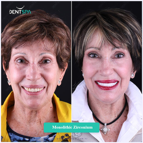 Couronnes Zircones — DentSpa Clinic