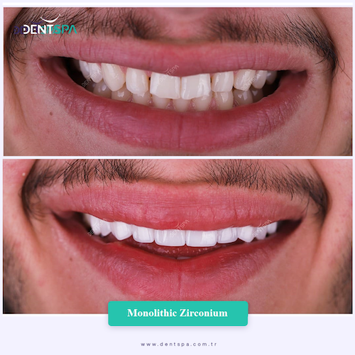 Couronnes Zircones — DentSpa Clinic
