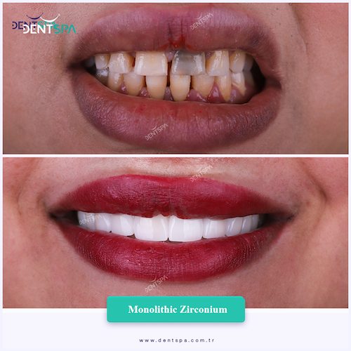 Couronnes Zircones — DentSpa Clinic