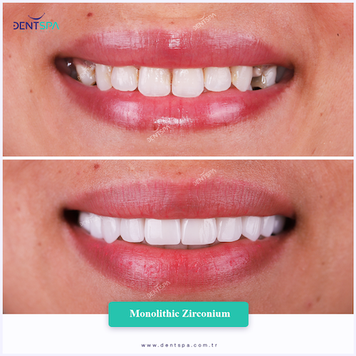 Couronnes Zircones — DentSpa Clinic