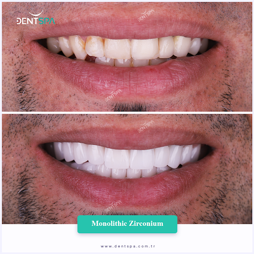 Couronnes Zircones — DentSpa Clinic