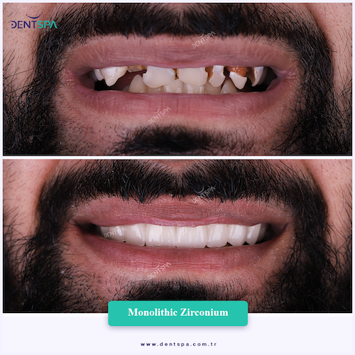 Couronnes Zircones — DentSpa Clinic