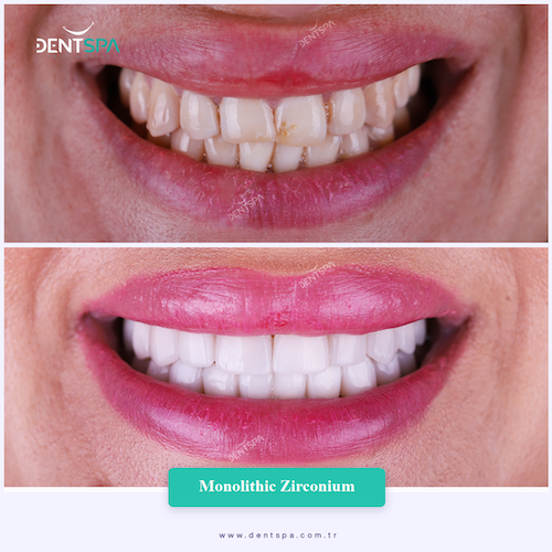Couronnes Zircones — DentSpa Clinic