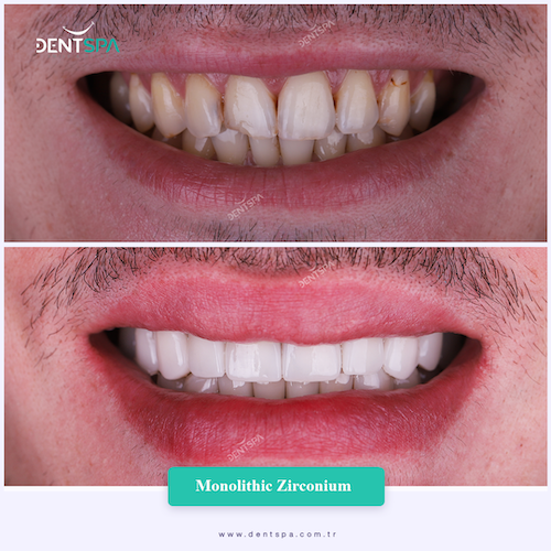 Corone zirconio — Dent Spa Clinic
