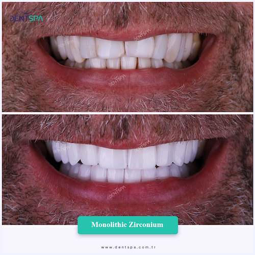 Corone zirconio — Dent Spa Clinic