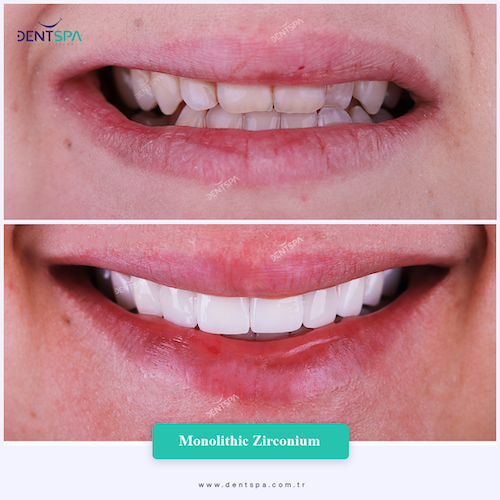 Corone zirconio — Dent Spa Clinic