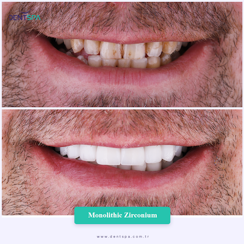 Corone zirconio — Dent Spa Clinic