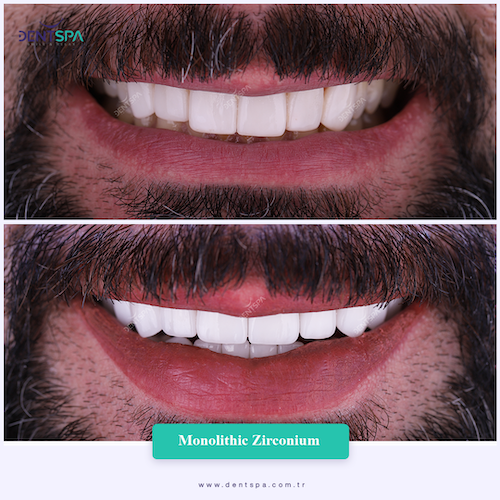 Corone zirconio — Dent Spa Clinic