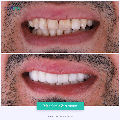 Corone zirconio — Dent Spa Clinic