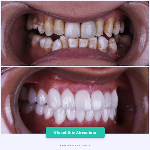 Corone zirconio — Dent Spa Clinic