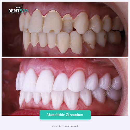 Corone zirconio — Dent Spa Clinic