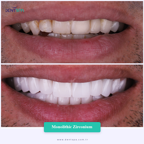Couronnes Zircones — DentSpa Clinic