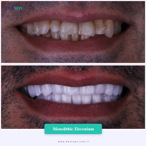 Couronnes Zircones — DentSpa Clinic