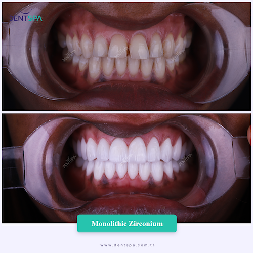 Couronnes Zircones — DentSpa Clinic